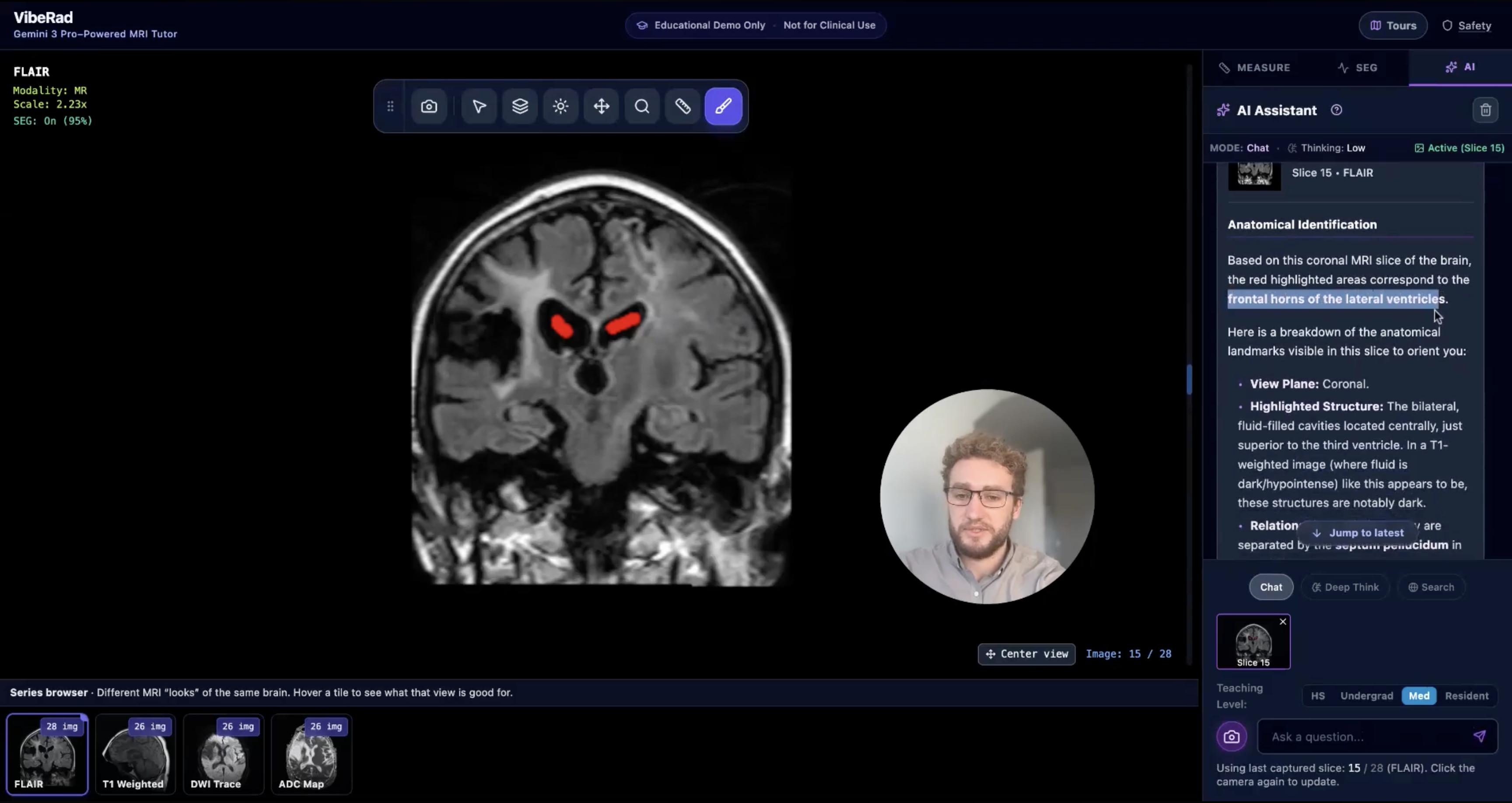 VibeRad anatomical teaching interface showing a brain MRI with an AI explanation panel
